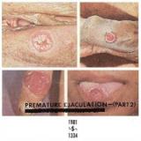PREMATURE EJACULATION